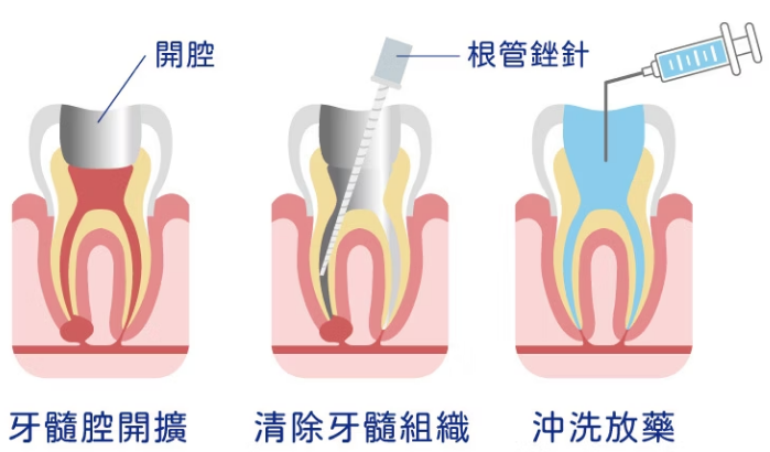 根管治療 根管治療