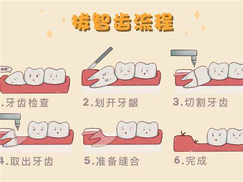 深圳拔智齿流程 深圳拔智齿流程