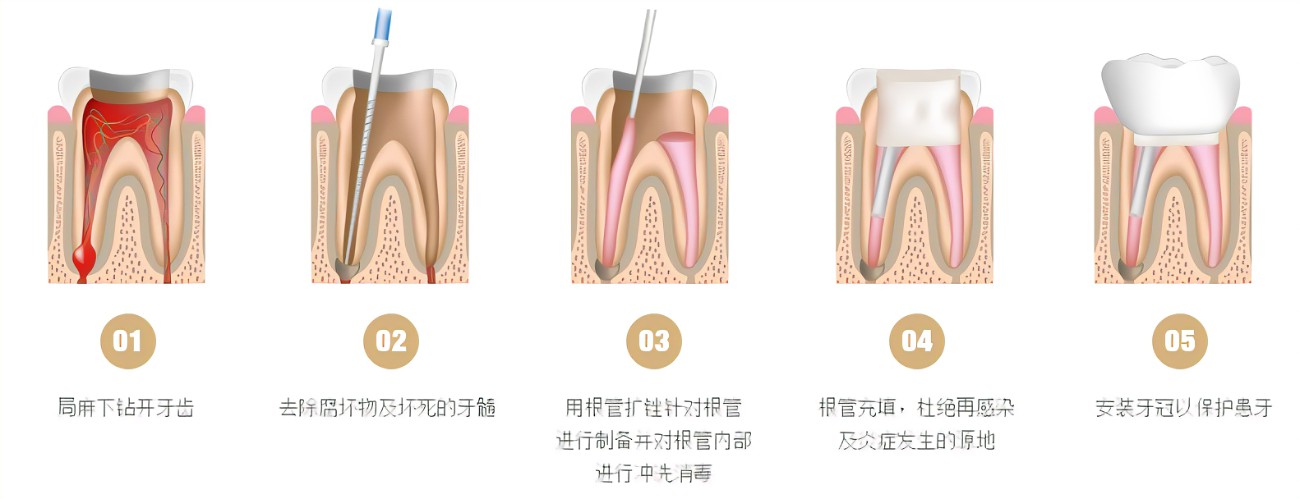 根管治疗的步骤 根管治疗的步骤