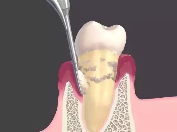 牙龈萎缩是如何引起的