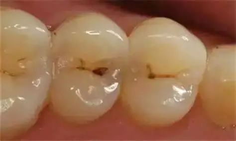 牙齒上的小黑點 牙齒上的小黑點