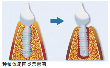 種植體周圍炎如何預防 種植體周圍炎如何預防