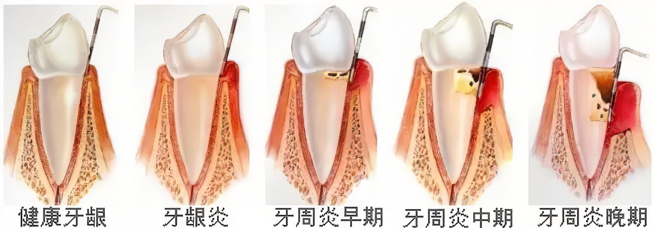牙周治療 牙周治療