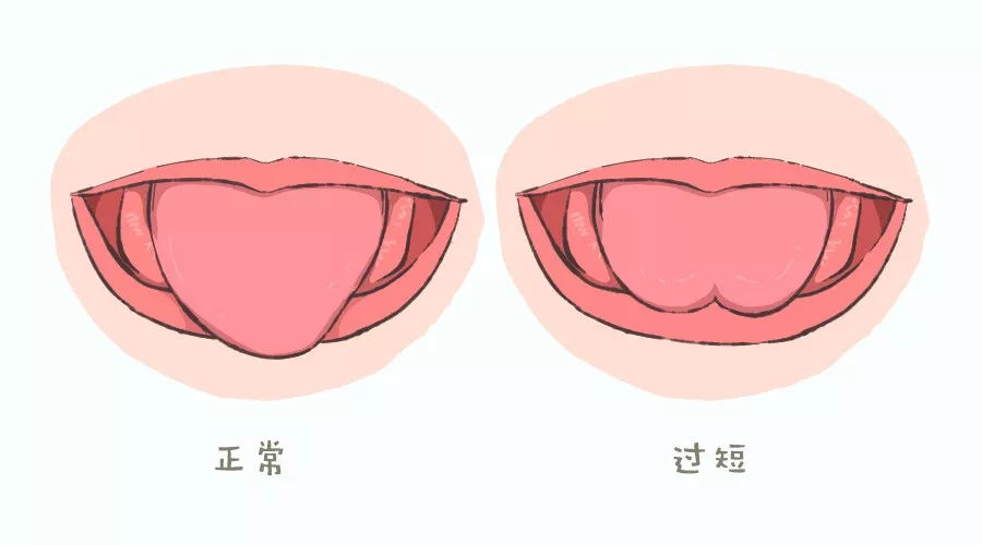 舌系带过短 舌系带过短