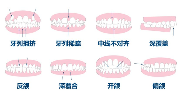 箍牙類型 箍牙類型