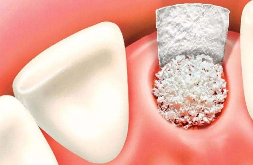 深圳種植牙植骨