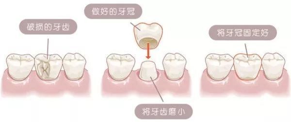 深圳全瓷牙 深圳全瓷牙
