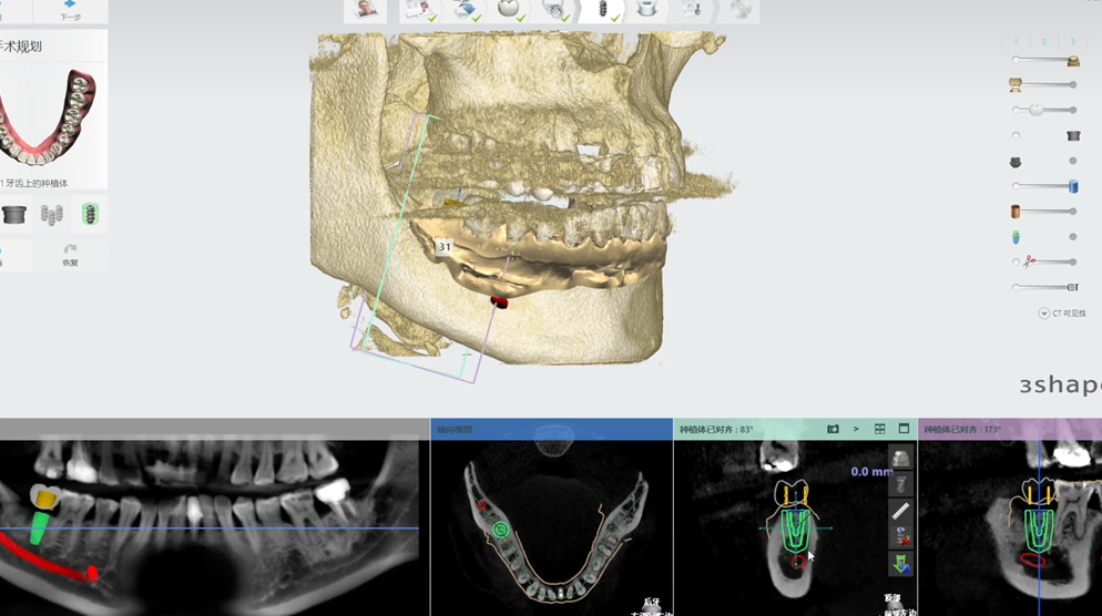 維港數字化種植牙