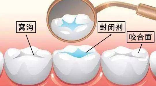 深圳補牙醫院推介