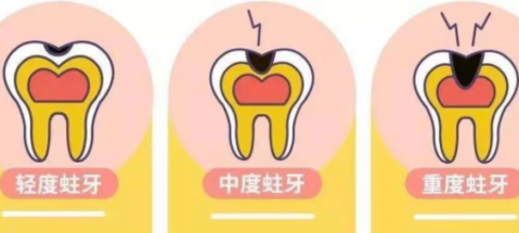 深圳補牙 深圳補牙