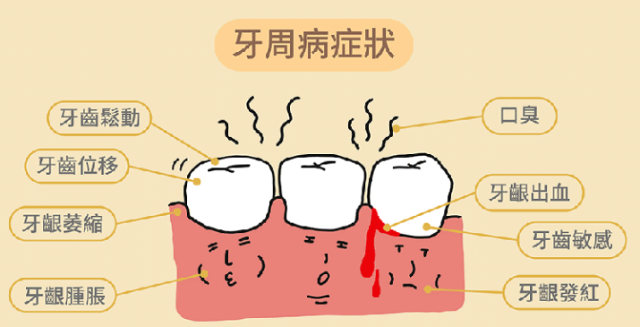 深圳牙周病 深圳牙周病