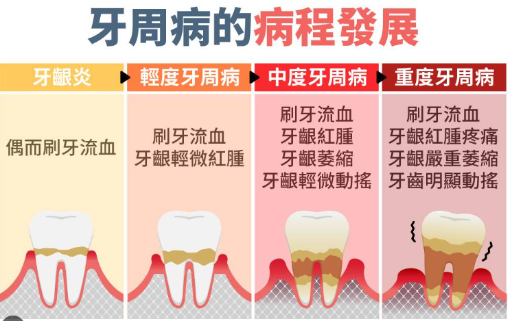 深圳牙周病 深圳牙周病