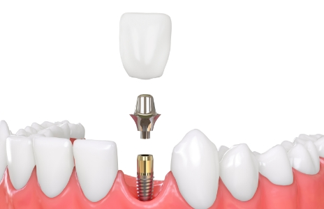 深圳維港口腔种植牙
