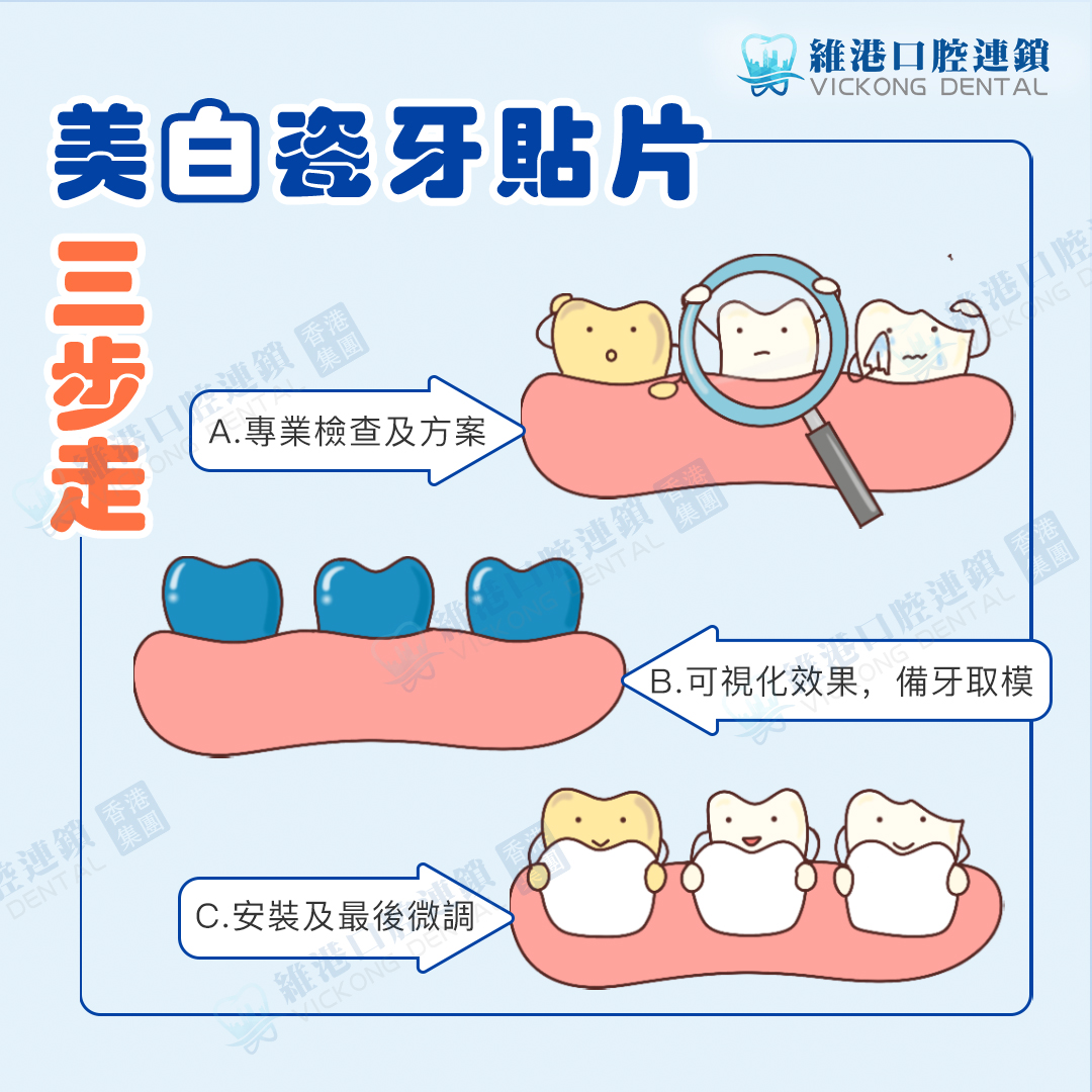 維港口腔美白瓷牙貼片