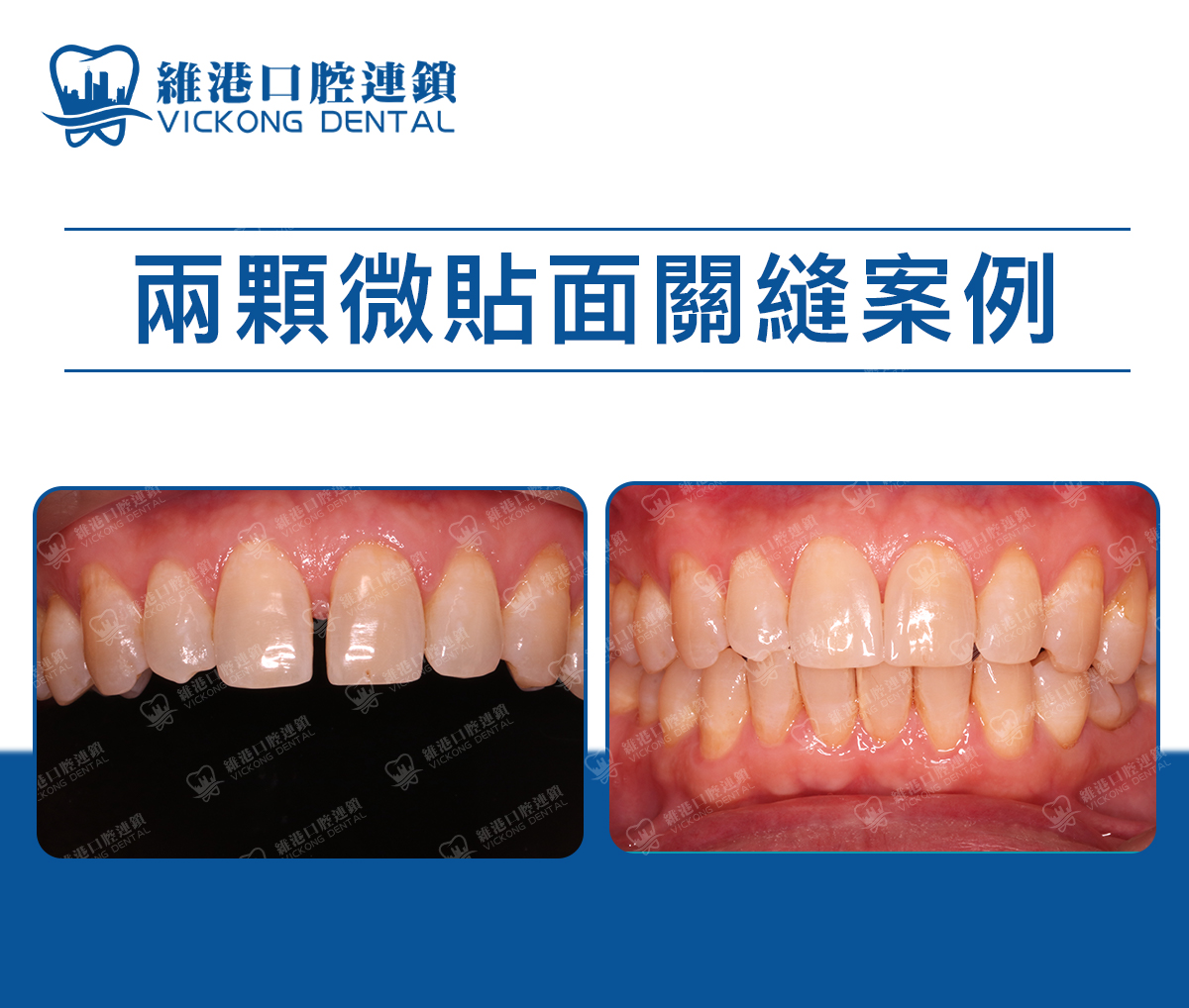 維港口腔牙貼面