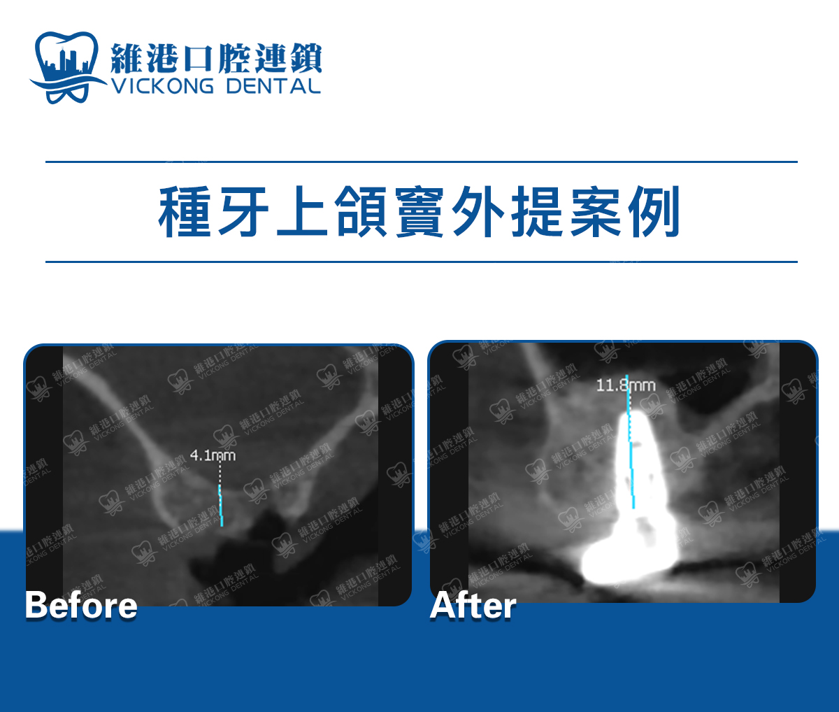 維港口腔上頜竇提升