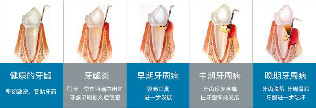 深圳治療牙周病 深圳治療牙周病