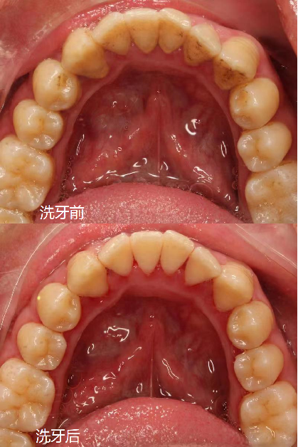 維港口腔洗牙前後對比 維港口腔洗牙前後對比