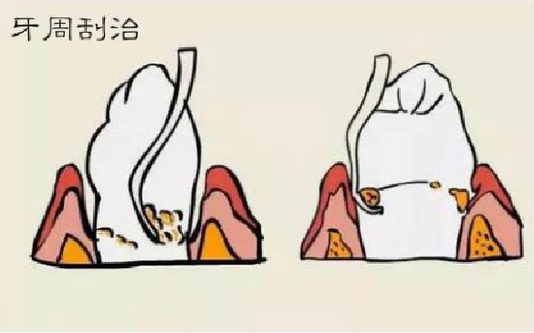 深圳深度洗牙 深圳深度洗牙