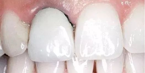 烤瓷牙出現黑線 烤瓷牙出現黑線