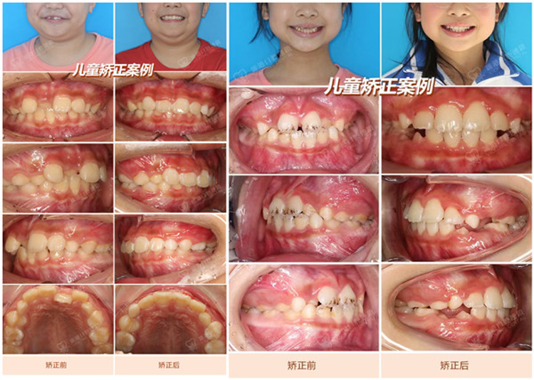 維港口腔兒童矯正案例 維港口腔兒童矯正案例