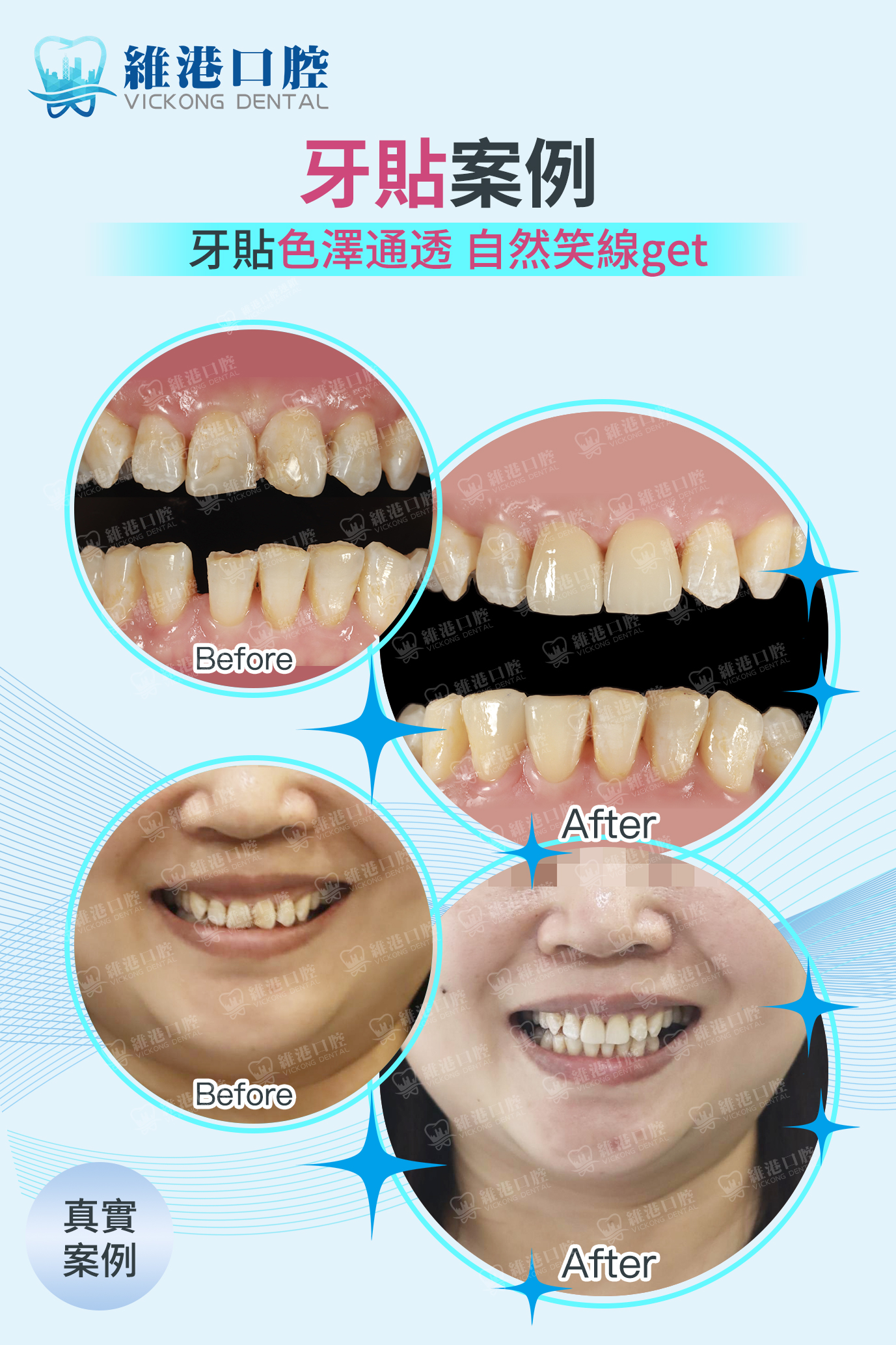 牙貼案例 牙貼案例