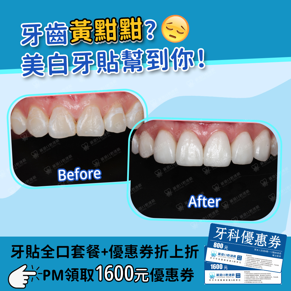 維港口腔做贴面 維港口腔做贴面