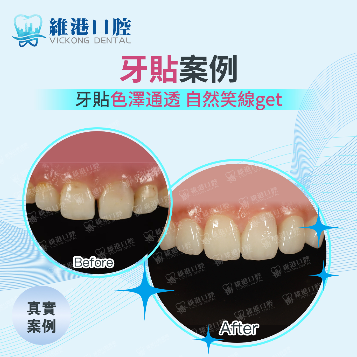 牙貼面案例 牙貼面案例