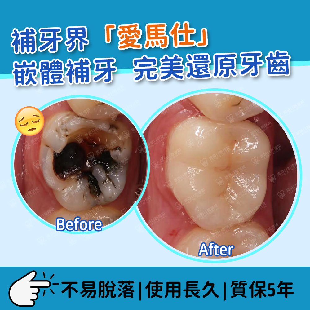 嵌體補牙完美還原牙齒