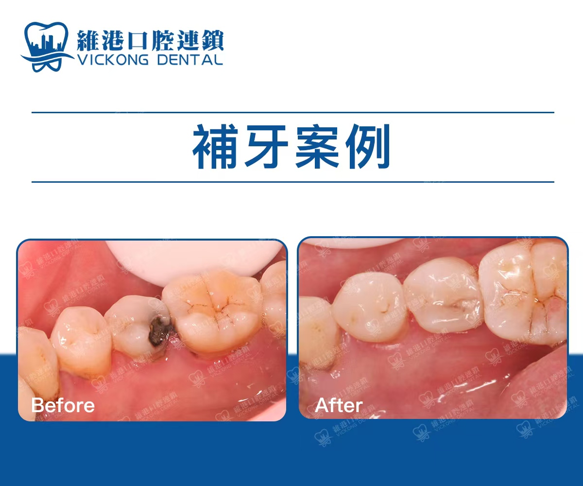 深圳維港口腔補牙案例