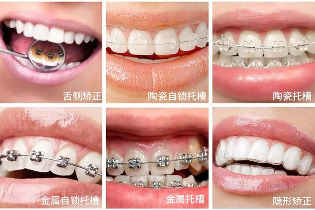 維港口腔暑期矯正