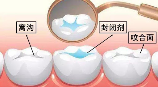 窩溝封閉劑是什麼成分？對小孩牙齒有害嗎？