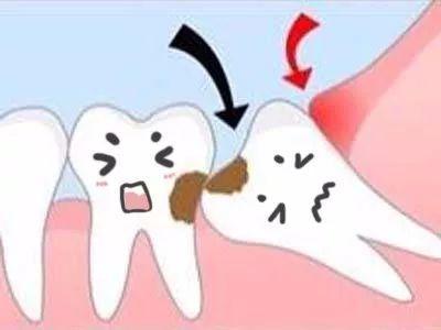 深圳拔智齒-什麼是智慧齒