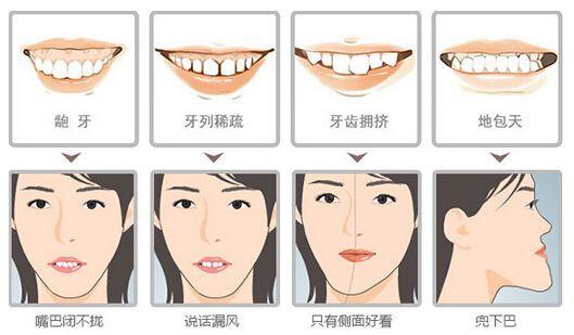 錯頜畸形箍牙